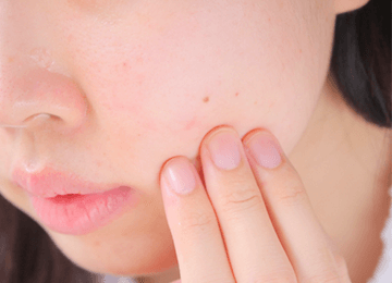 ニキビ・吹き出物